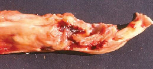 The rupture is usually seen as irregular, transverse interruption just above the tarsal joint. Among the haematoma, the free end of the tendon could be seen.