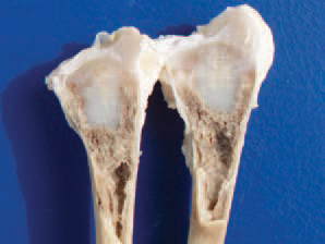 Dyschondroplasia is a defect of the growth plates in meat type poultry. It is characterized by abnormal cartilage masses under the growth plates of long bones. Most commonly, it is established in the proximal tibiotarsus and that is why it is called tibial dyschondroplasia. Dyschondroplasia could be also seen in the proximal and distal femur, the distal tibia and the proximal humerus. Clinically, affected chickens exhibit reluctance to move and lameness. Fractures could also be seen. The aetiology of dyschondroplasia is related to genetic factors, rapid growth in broilers, vitamin D metabolism, mycotoxins etc.