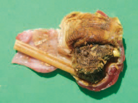 The gizzard impaction could results in high mortality in turkey poults during the first three weeks of life. Affected turkey poults are dehydrated, with empty gut, but the gizzard is filled with hard fibrous masses.