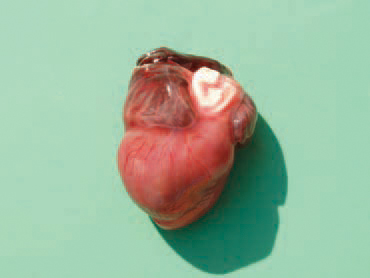 The aetiology is not known, but genetic factors or early viral myocarditis is supposed. The state is lethal in turkeys at the age of 1 - 4 weeks. Pathoanatomically, a severe dilated cardiomyopathy, often accompanied with ascitis, hydropericardium and congestion of other organs is detected.