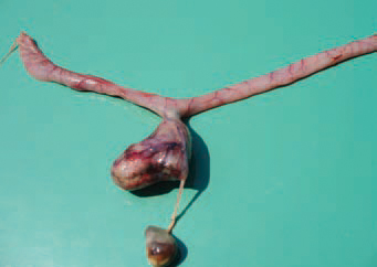 A sacciform blind pouch occurring after attachment of the intestinal wall to an unabsorbed yolk sac, causing impaction.